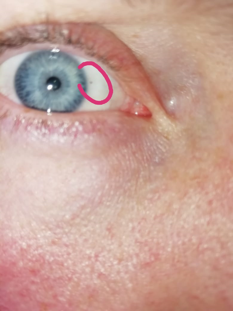 Травма глаза: первая помощь и лечение травмы глаза, причины и симптомы